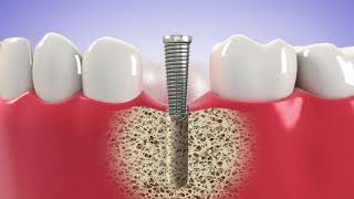 Dental Implants in Guelph, Ontario
