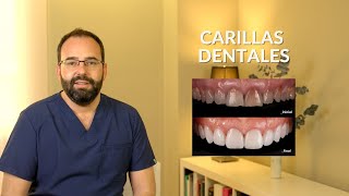 CARILLAS DE PORCELANA O DE COMPOSITE: ¿Cuáles elegir