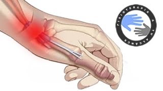 Tendinitis de Quervain o muñeca, que es y como se produce