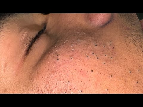 The Ultimate Facial Care Routine For Acne — Blackhead Removal Secrets