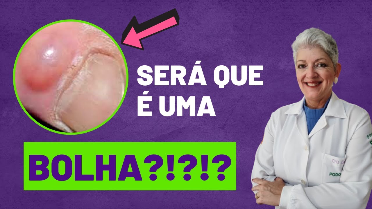 CISTO MUCOSO DIGITAL Saiba o que é