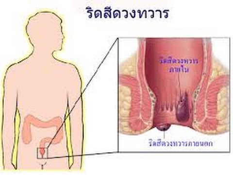รักษาเยียวยา neurodermatitis พื้นบ้าน การรักษาอาการแพ้ภูมิแพ้