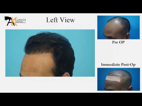 Hair Transplant Videos Before After Result Videos In India