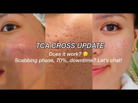 Tca Cross Reddit