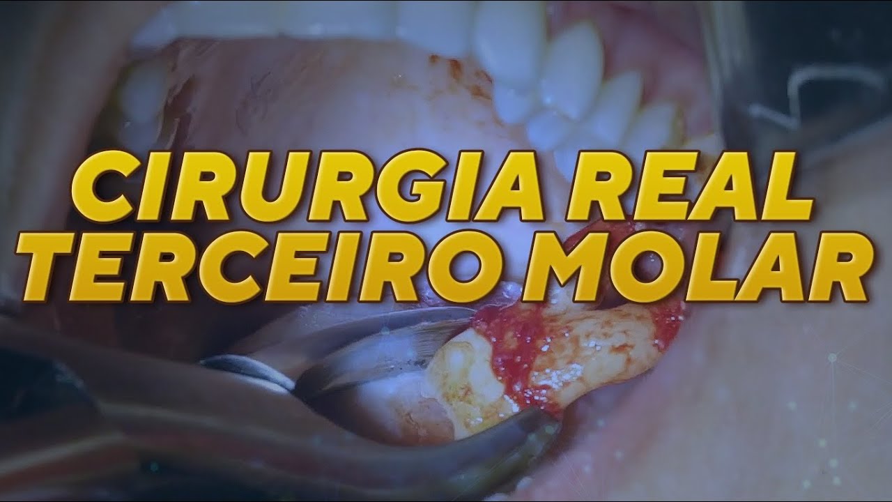 Cirurgia real de dente semi-incluso (dente 28)
