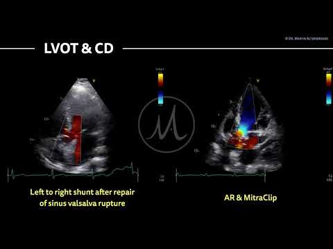 〖Echocardiography〗 Shunt lesion, AR, MitraCllip in 5-ChV