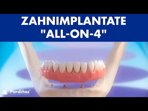 Zahnimplantate «All-on-4» ©