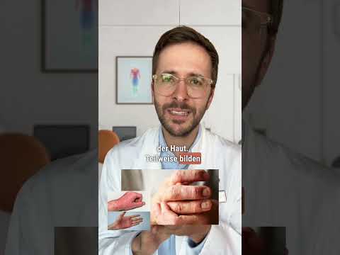 So sieht ein Handekzem aus! | DERMAFY #shorts