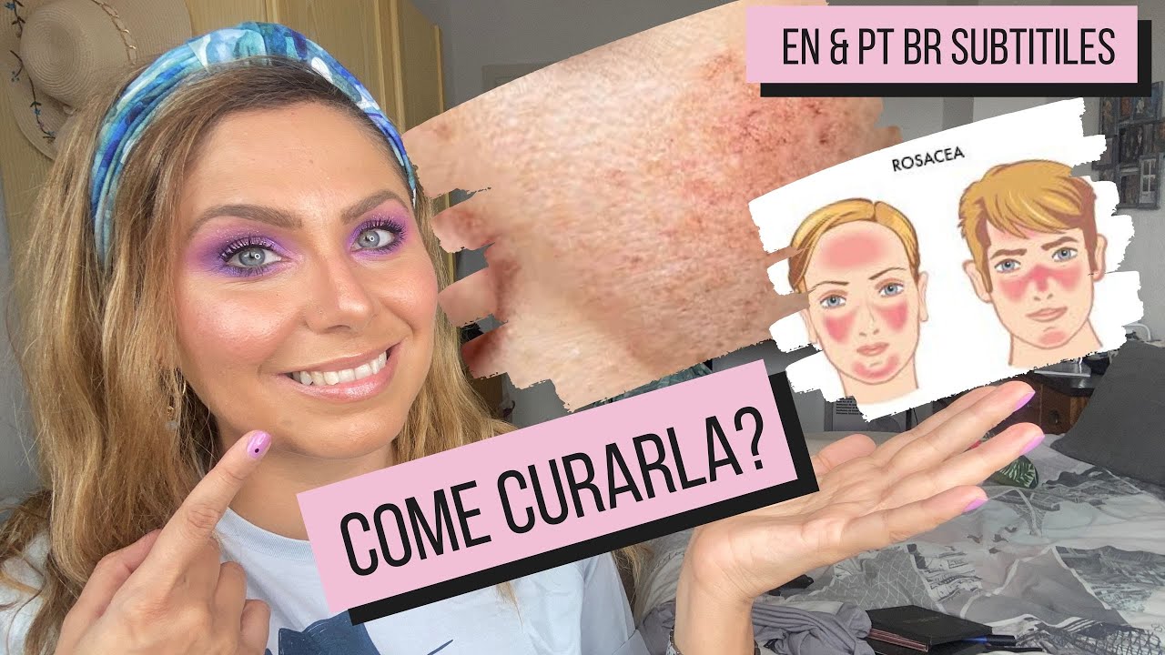 Watch Now Rosacea: cos'è e come curarla con la skincare | Skin Edit Rosacea: cos'è e come curarla con la skincare | Skin Edit