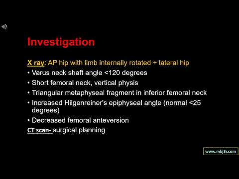 Developmental Coxa Vara. Dr Mallinath G. Manipal Hospitals. Bangalore