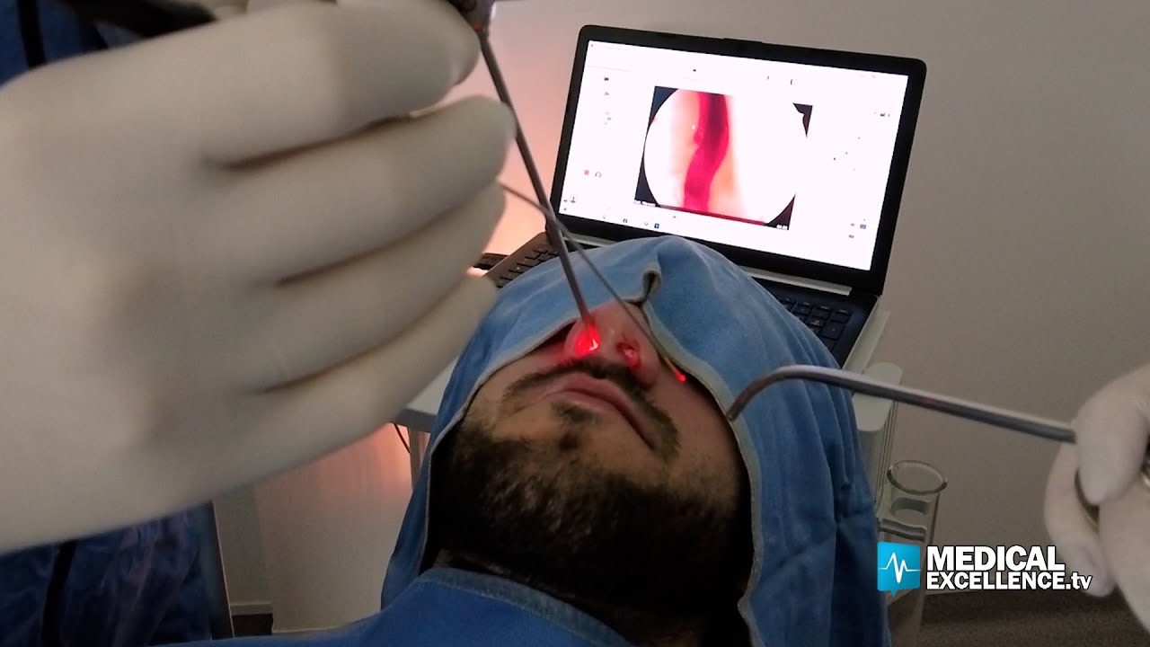 Ipertrofia dei turbinati, tornare a respirare bene grazie al laser a diodo