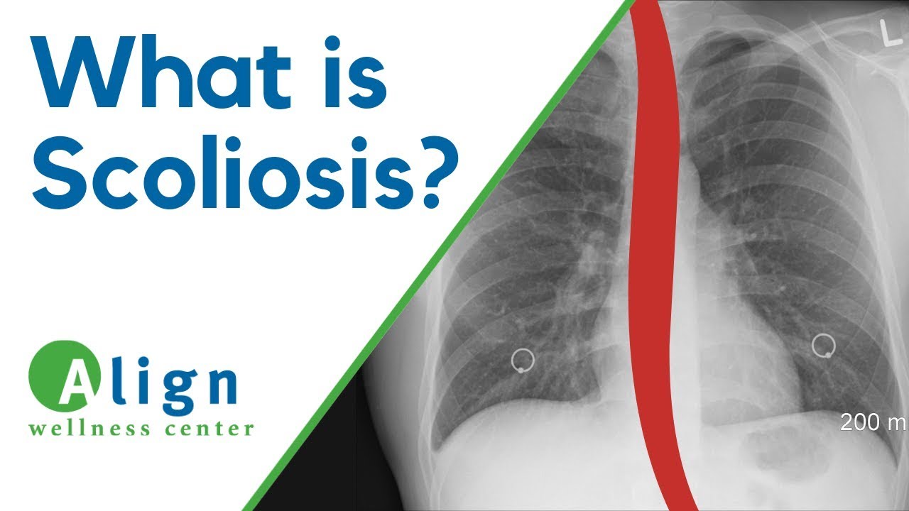 What Is Scoliosis Of The Spine? (Chiropractor from Northbrook, IL)