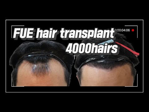 Hair transplant in Korea.FUE hair transplant 4,000 hairs / The cost is 5.9 million won.