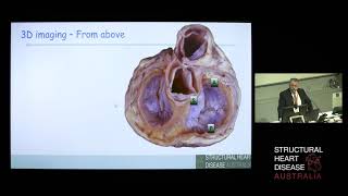 Imaging the Tricuspid Valve – Prof Greg Scalia
