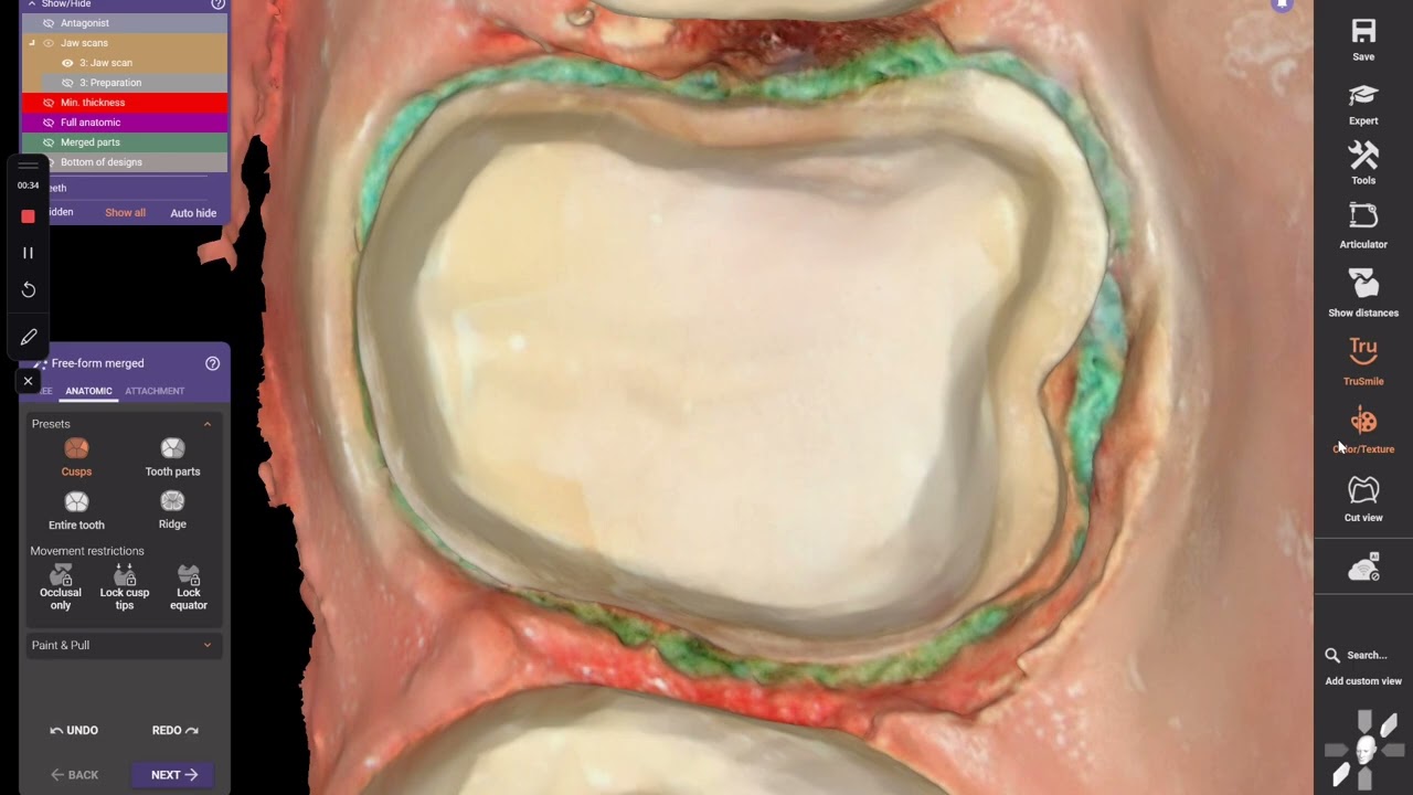 Shining Elf- exocad -MIDAS 