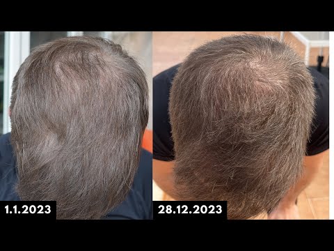 Topical Finasteride 1 Year Update