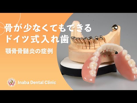 骨が少なくてもできるドイツ式入れ歯〜顎骨骨髄炎の症例〜