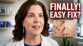 The Truth About Removing Skin Barnacles/Seborrheic Keratoses