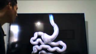 Sleeve Gastrectomy Surgery Explained
