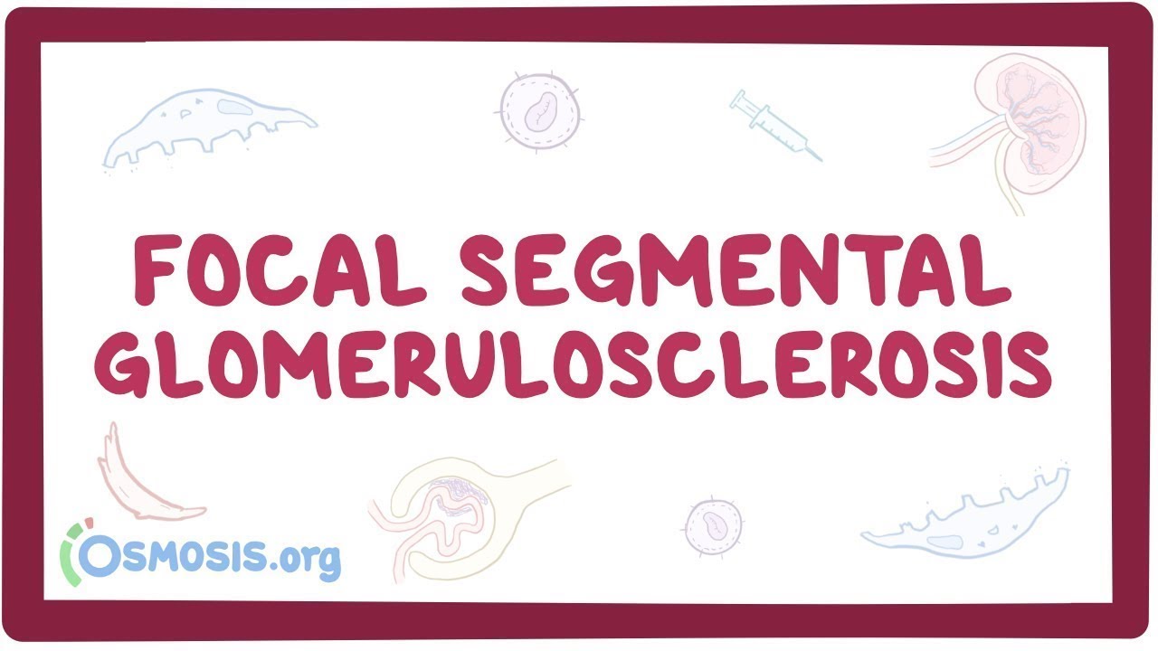 Focal Segmental Glomerulosclerosis - causes, symptoms, diagnosis, treatment, pathology