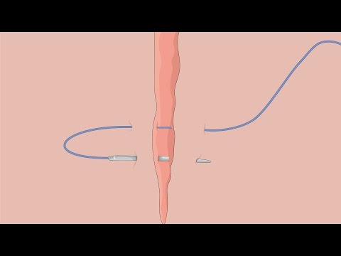 Surgical Skills: Horizontal mattress suture.