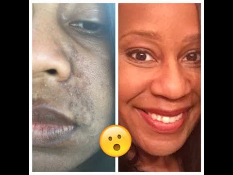 Seborrheic Dermatitis - THIS May Be Making It Worse