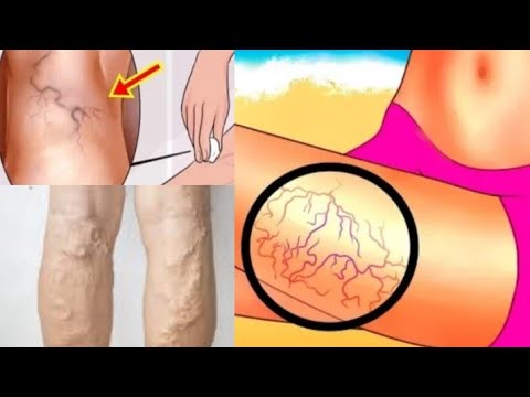 tratamentul vulturului cu laser varicoza varicoasa unguent i geluri în legume varicoase