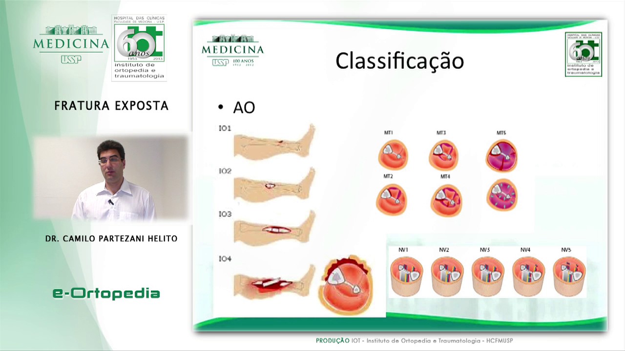 Fraturas Exposta - Dr. Camilo Partezani Helito