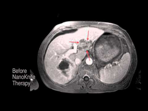 Nanoknife for Cancer