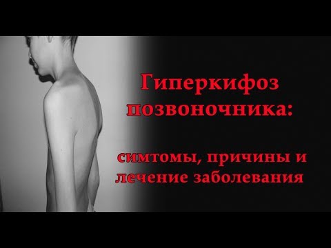 Питание при сколиозе меню Исправить сколиоз и перекос таза