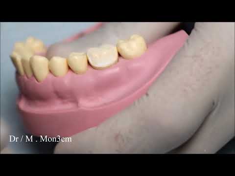 Full Veneer metal crown prep