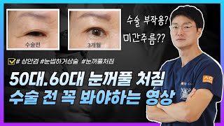 처진 눈, 상안검 수술 고민이신 분들 시청해 주세요!