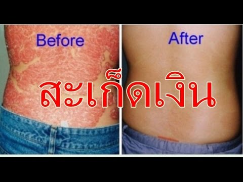 ห่อในโรคสะเก็ดเงิน Dayvoneks ในการรักษาโรคสะเก็ดเงินสำหรับเล็บ