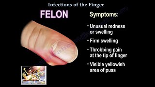 Infections Of The Finger - Everything You Need To Know - Dr. Nabil Ebraheim