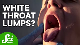 Why Do I Have Tonsil Stones?