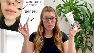 HOW TO CURE PERIORAL DERMATITIS FAST! (I FOUND THE SECRET SAUCE)