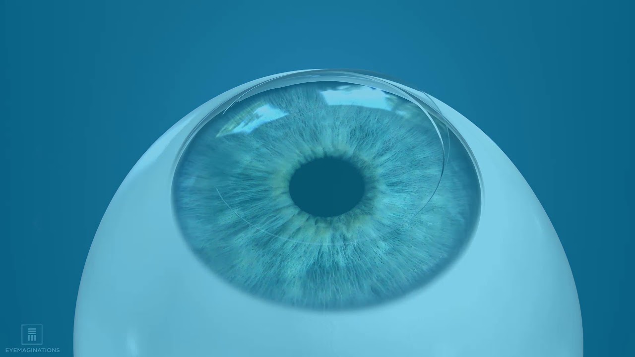 Laser Eye Center YouTube Video