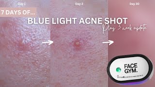 7 Days of Facegym Blue Light for Acne PLUS 3 WEEK UPDATE