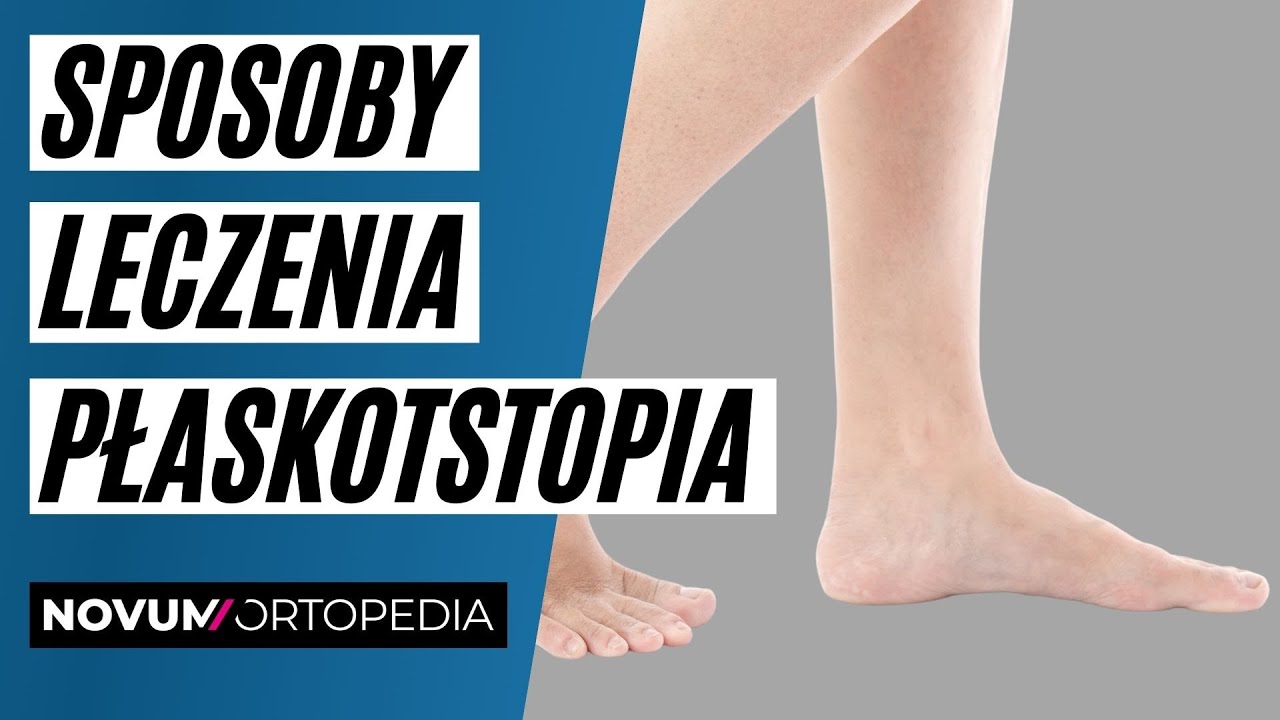 Przyczyny i sposoby leczenia stopy poprzecznie płaskiej | Novum Ortopedia