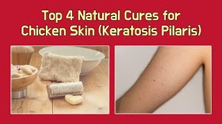 Top 4 Natural Cures for Chicken Skin (Keratosis Pilaris)