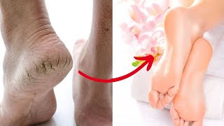 Acabe com os pés rachados por 12 reais (protocolo simples)