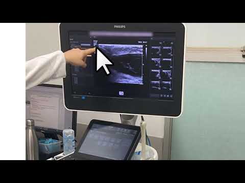 Sugestão de técnica para punção guiada por ultrassonografia de seroma adjacente a prótese mamária.