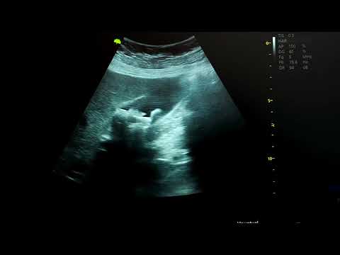 PAIN UNDER THE RIGHT RIB, NAUSEA, GASTROINTESTINAL DISCOMFORT