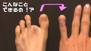 【足趾移植術】足の指を手に移植したけど質問ある？