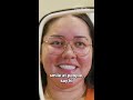 Upgrade Your Smile: Dentures vs. Implants