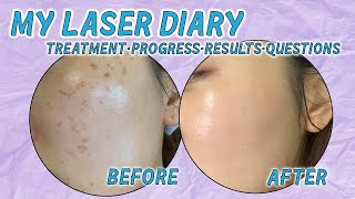 Getting Rid of my Dark Spots and Hyperpigmentation | Crystall Cho