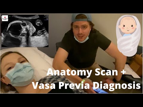 diagnosed with vasa previa | anatomy scan vlog