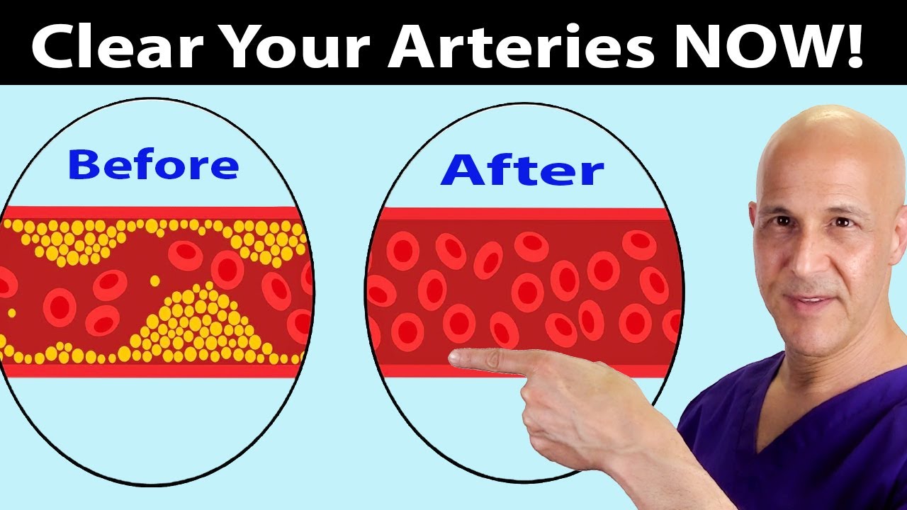 Eat These Foods to Clear Arteries FAST (Stop Heart Attacks & Strokes)  Dr. Mandell