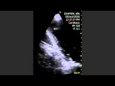 Thrombus Of The Left Heart Compartment