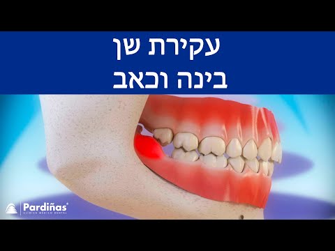 © עקירת שן בינה וכאב